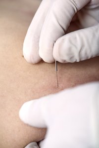 Dry needling