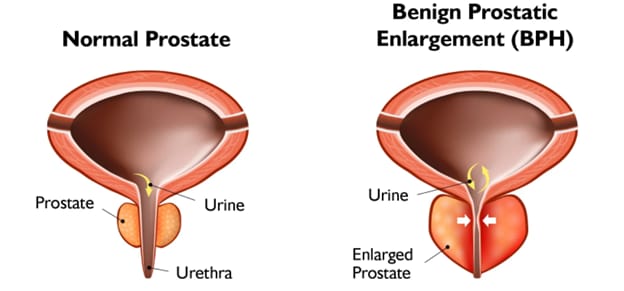 Prostate illustration - normal versus BPH